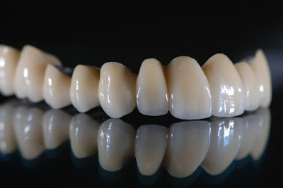 Răng sứ titan có bị đen không khi sử dụng? 2