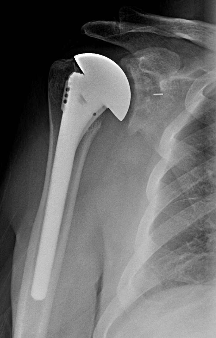 Shoulder Arthritis/Joint Replacement Rotator cuff tears What does a