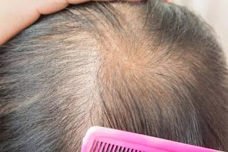 How To Regrow Hair | 10 Remedy To Fight Hair Loss And Regrow Hair