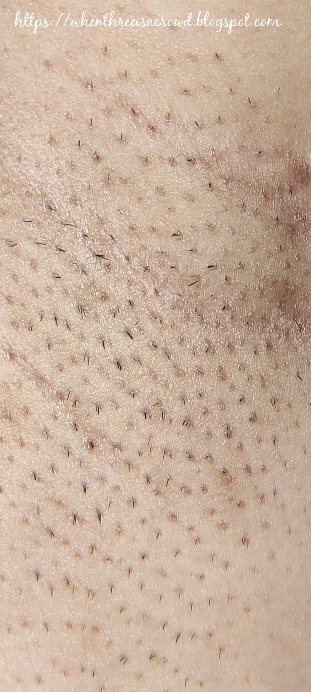 writing down my emotions Skin Station Diode Laser Underarm (1st Session)