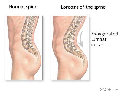 lordosis-perut-buncit