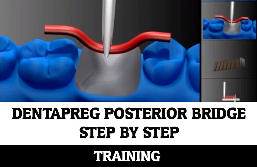 DENTAPREG Posterior Bridge Training Step by Step