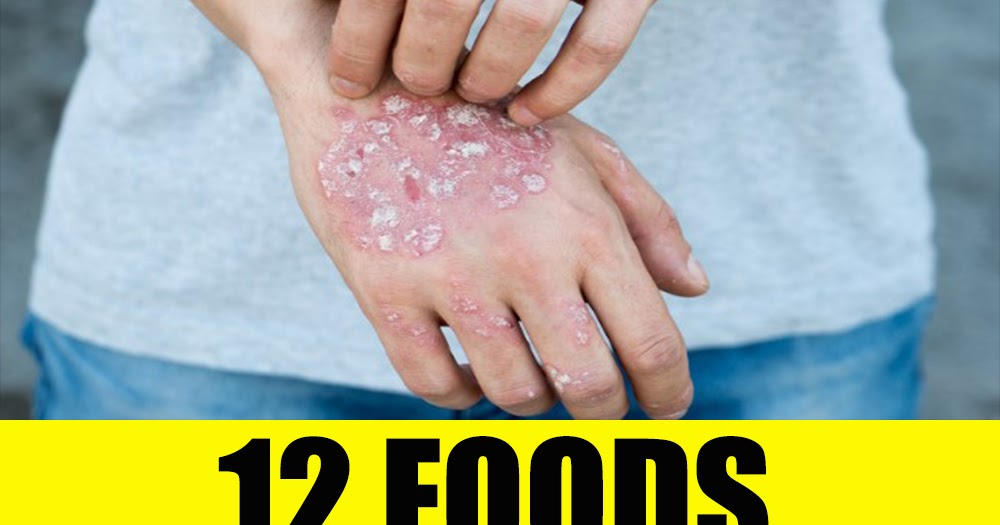 DIYNatural Health 12 Foods that Make Eczema Worse