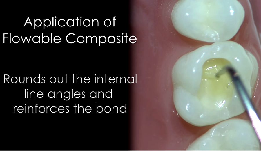 COMPOSITE RESTORATION Class I step by step Dr. Jason Smithson