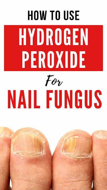 How To Use Hydrogen Peroxide For Nail Fungus – A Step By Step Guide