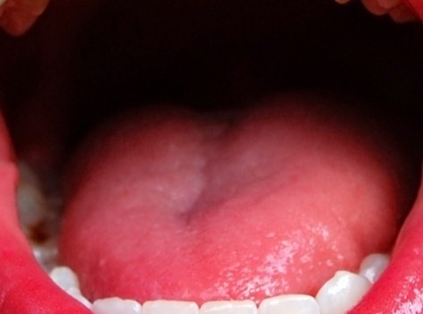 pictures of yeast infection in mouth #10
