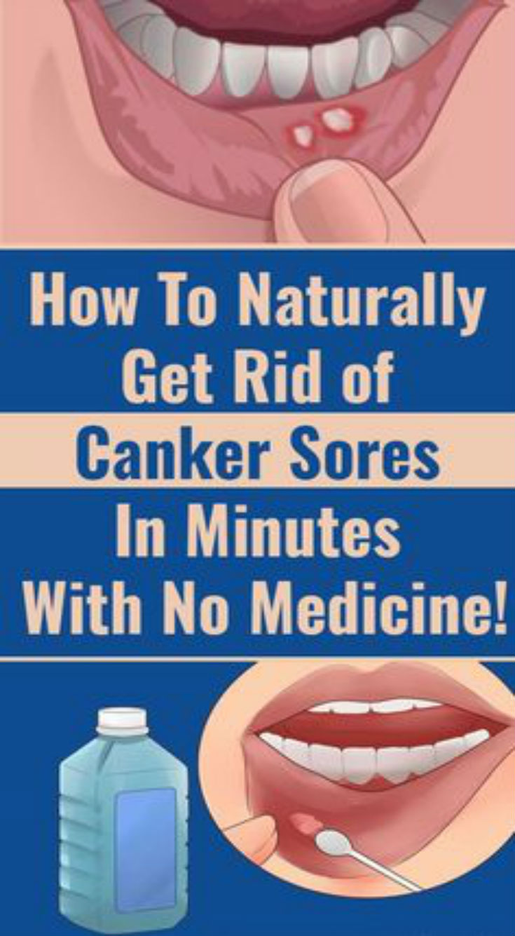 How To Cure Canker Sores And Mouth Sores Healthpinspopular how-to-cure-canker-sores-and-mouth-sores-healthpinspopular