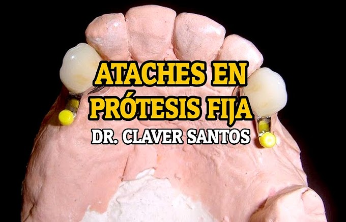 WEBINAR: Ataches en Prótesis Fija - Clase Magistral del Dr. Claver Santos