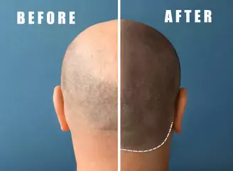 receding hairline treatment receding hairline treatment