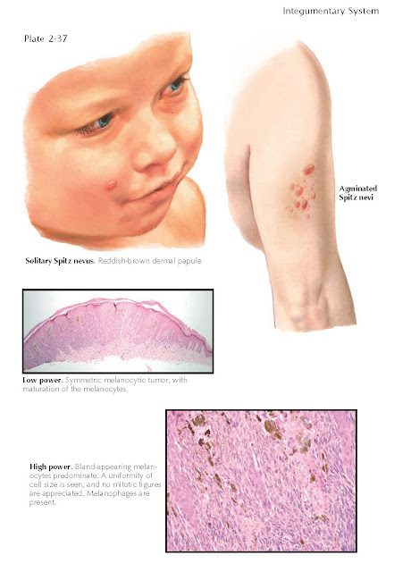 SPITZ NEVUS, atypical Spitzoid melanocytic lesion, atypical Spitz nevus, Spitzoid tumor of undetermined potential