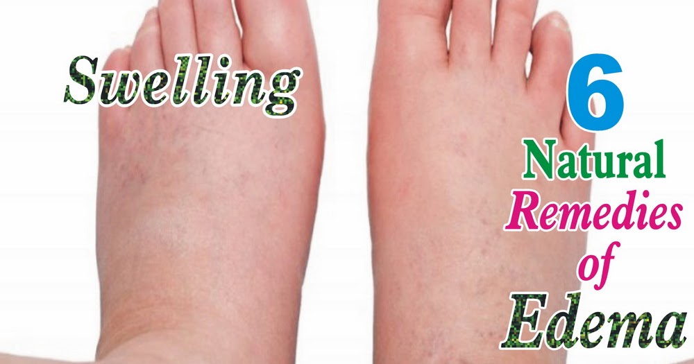 How to Treat Edema Natural Treatment of Edema VB