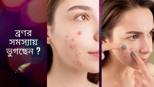 Pimples problems ব্রণর হাত থেকে রেহাই পেতে এই বিশেষ কাজগুলো করুন