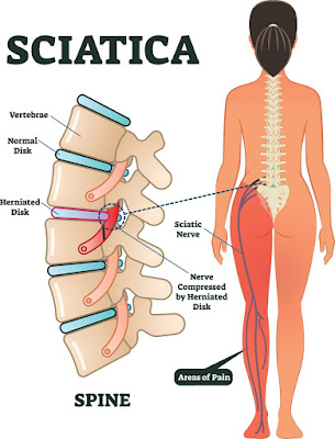 sciatica pain