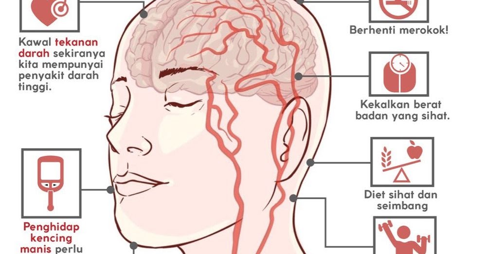 Fantastis 30 Gambar Kartun Penyakit Stroke - Gambar Kartun Mu