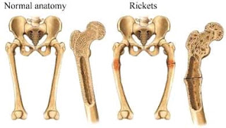 Normal bones vs rockets disease bones