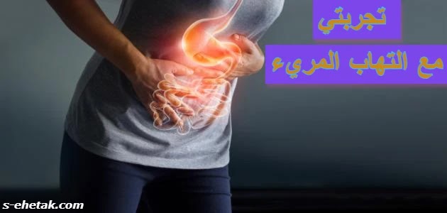 تجربتي مع التهاب المريء تجربتي مع التهاب المريء