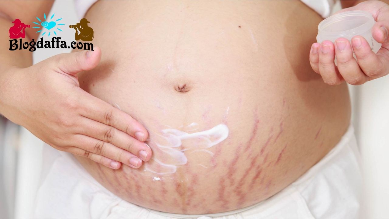 Menghilangkan Stretch Mark dengan lemon Manfaat buah lemon untuk menghilangkan Stretch Mark