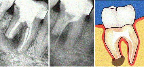 apseli iltihapli dis cekilir mi