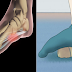 10 Technique On How to Fix Health Problems Brought About By Having Flat Feet