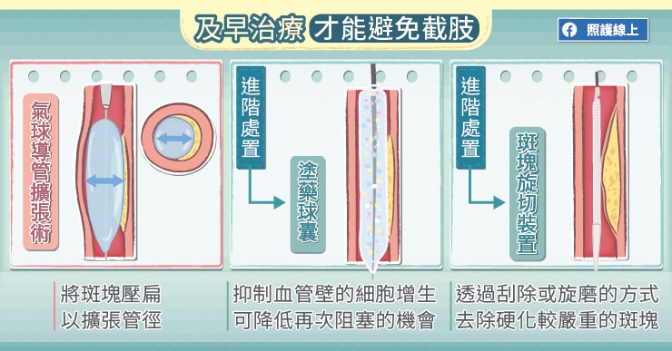 及早打通血管，才能避免截肢