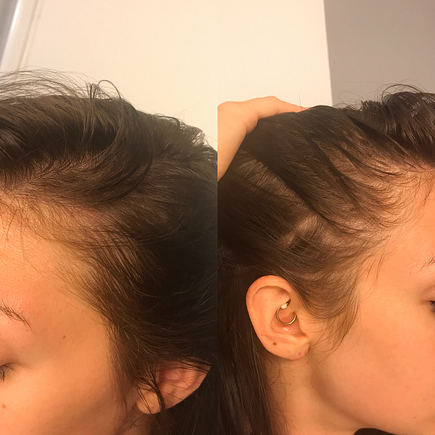 Telogen Effluvium & Hormonal Hair Loss/Thinning Update What Has Worked