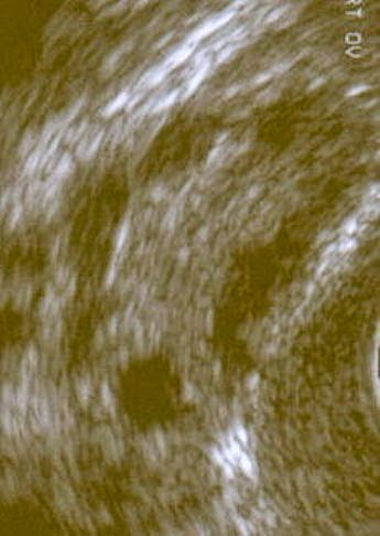 ujian imbasan ovari ultrasound pcos