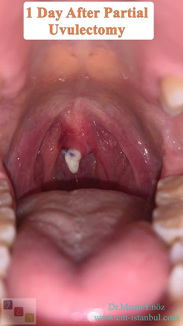 Oral Papillomas (Warts),uvulectomy,Papilloma of Uvula,oral HPV infection,Human Papillomavirus,Partial uvulectomy,