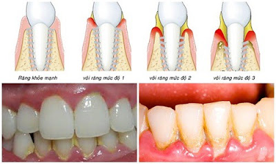 Vôi răng có ảnh hưởng gì? 