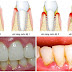 Những tác hại do vôi răng gây ra