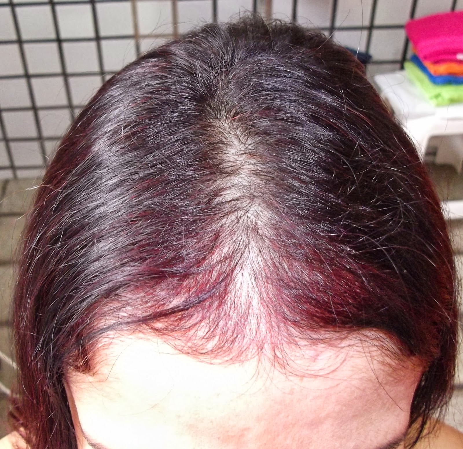 What is telogen effluvium ? hair loss doctor
