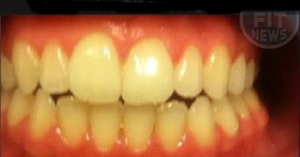 How To Get White Teeth In A Week Naturally How To Get White Teeth In A Week Naturally