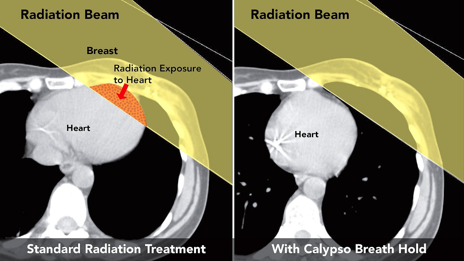 Side Effects Of Radiation For Lung Cancer Effect Choices