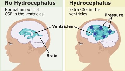 A Comprehensive Guide To Hydrocephalus: What You Need To Know.