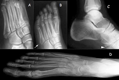 Fifth metatarsal base fractures