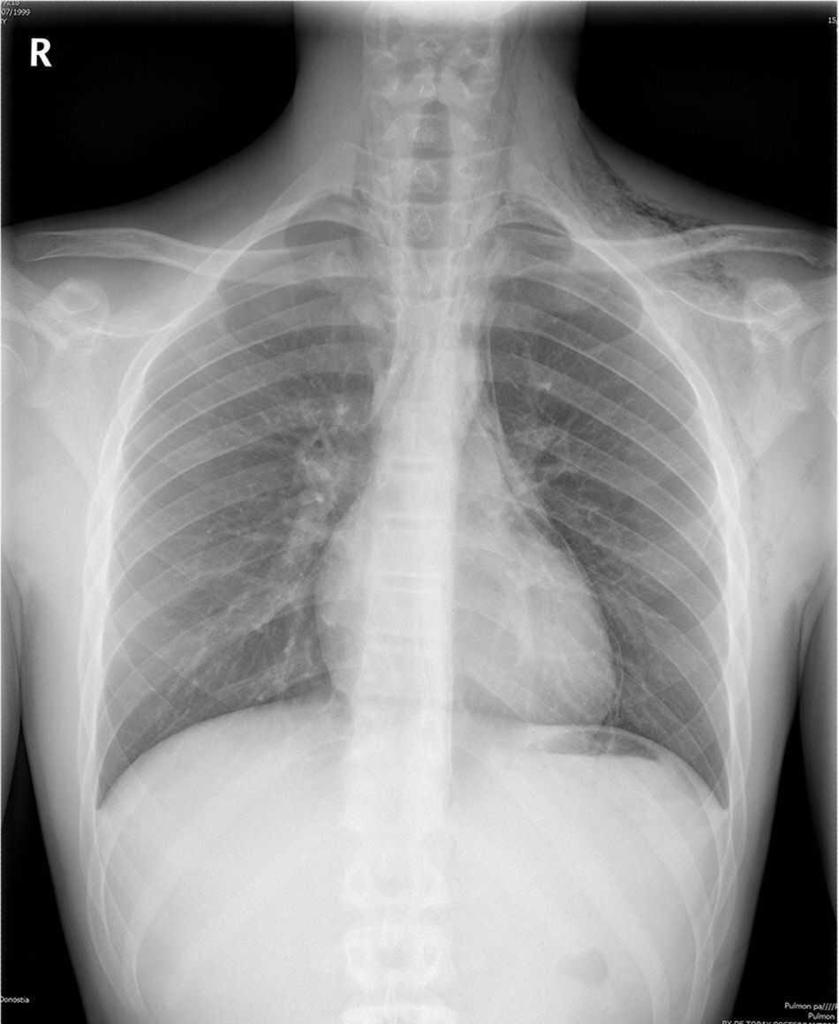 Alteraciones en la placa de Torax : Alteraciones en radiografía del tórax