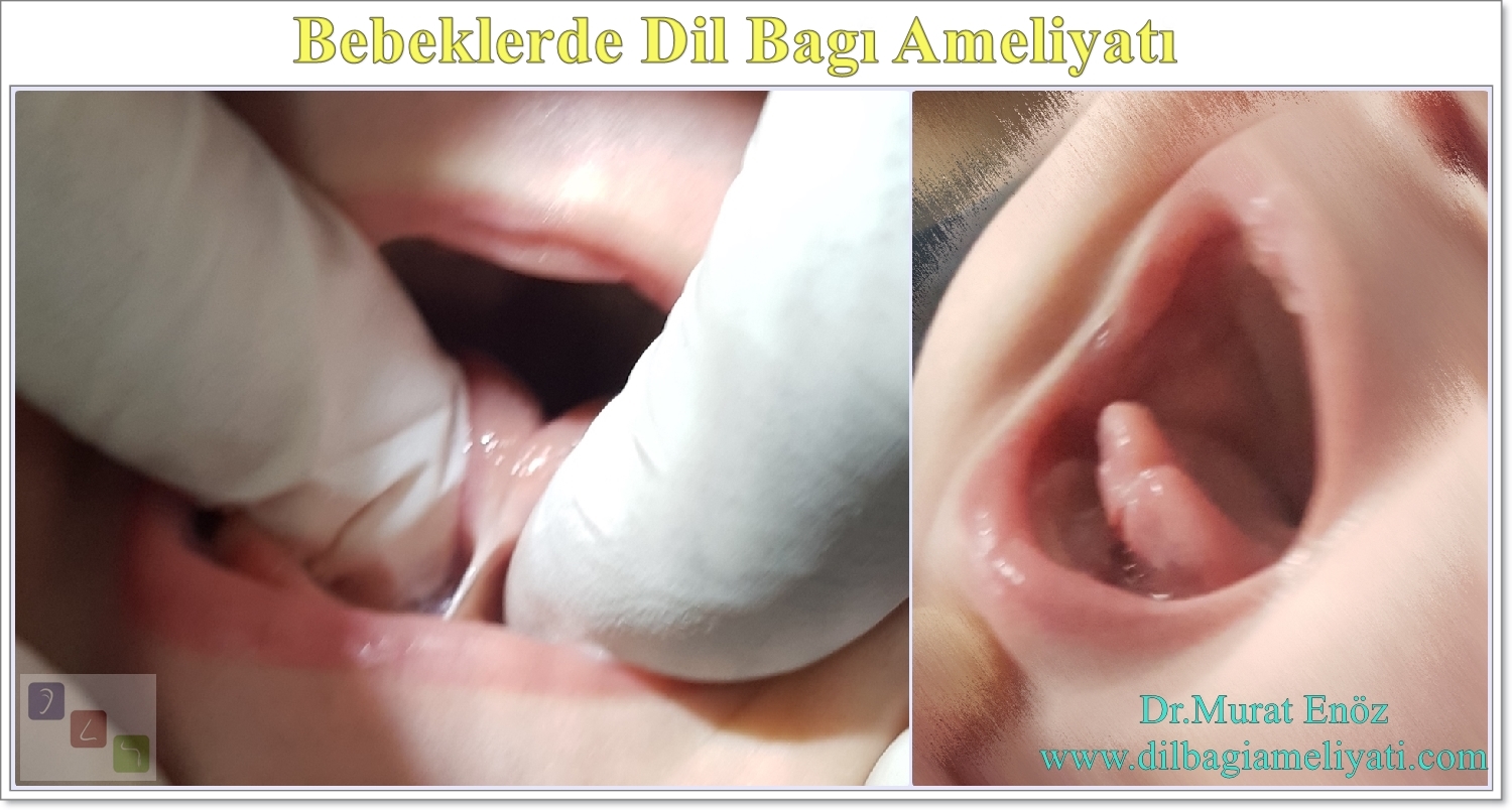 Ofiste ve Lokal Anestezi Altında Yapılan "Bebeklerde Dil Ofiste ve Lokal Anestezi Altında Yapılan "Bebeklerde Dil