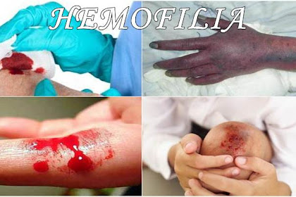 Obat Herbal Hemofilia