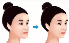 Phẫu thuật hàm hô cho gương mặt cân đối