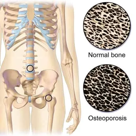 Askep Osteoporosis Sdki Slki Siki