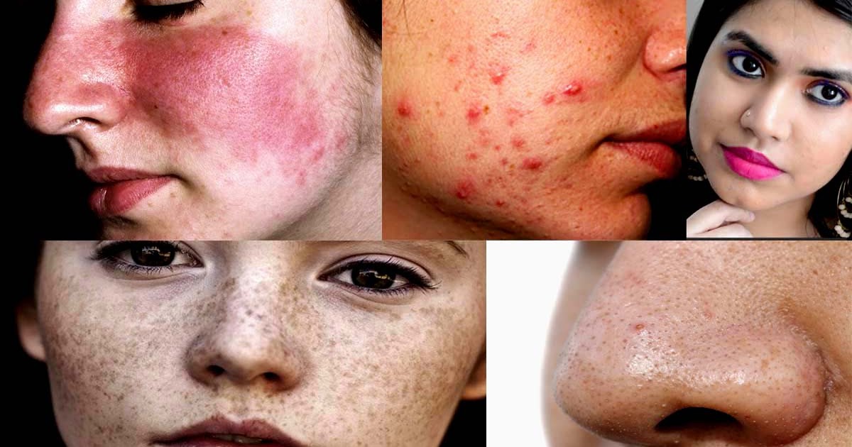Get rid of acne scars, blackheads, black spots, sunburn spots in just