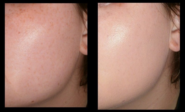 base london pimple 3eye lace