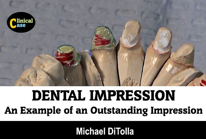 DENTAL IMPRESSION: An Example of an Outstanding Impression - Michael DiTolla