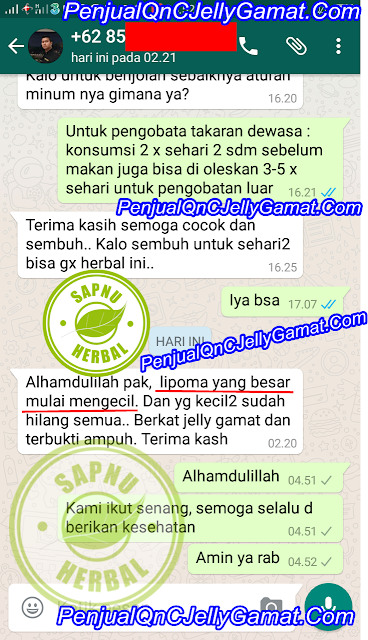 Cara Menghilangkan Lipoma Pada Tubuh Secara Alami dan Cepat Cara Menghilangkan Lipoma Pada Tubuh Secara Alami dan Cepat