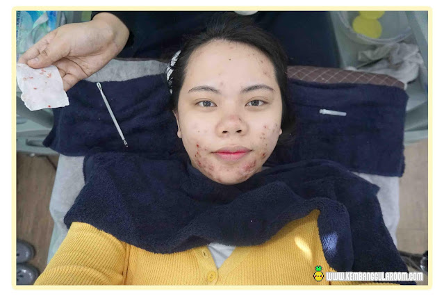 Acne Care Treatment di TIUwoo Korean Beauty, Perawatan Wajah untuk Kulit Berjerawat