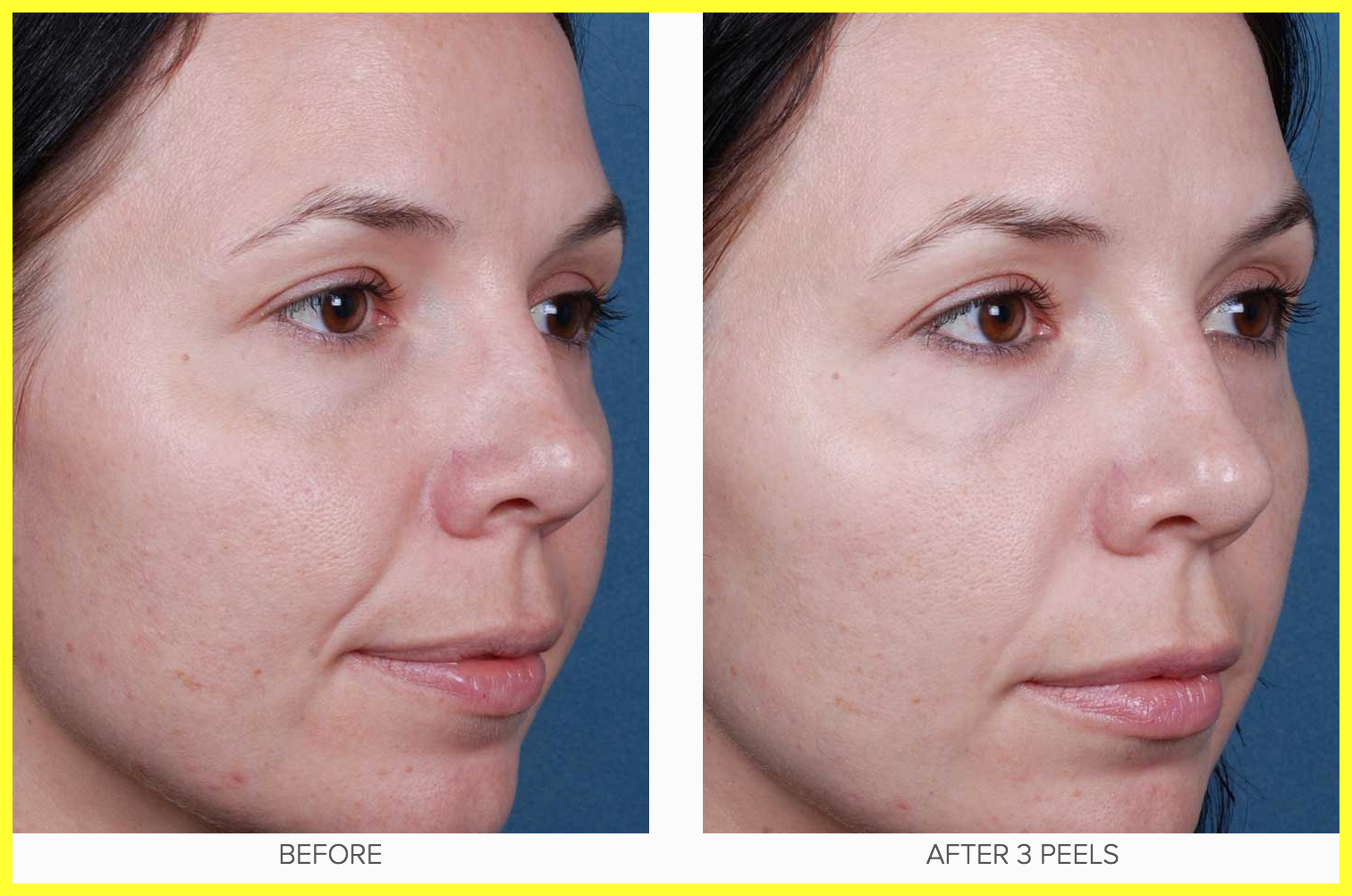 A New Feel With The Obagi Blue Peel Radiance My Health A New Feel With The Obagi Blue Peel Radiance My Health