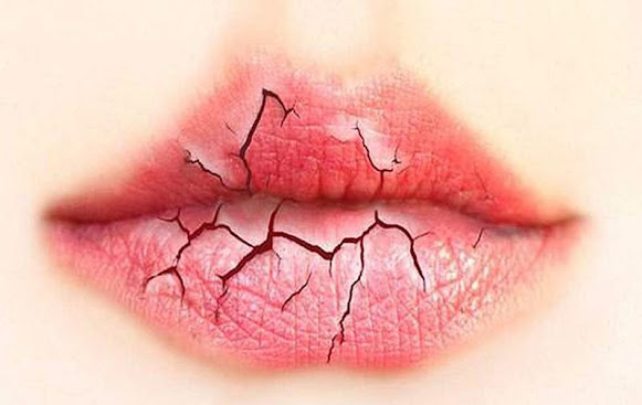 Severe bad breath, how to overcome this situation Dry mouth is the main cause of bad breath