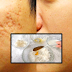 How To Get Rid Of Large Pores And Deep Scars Naturally And Permanently With Rice, Milk and Honey