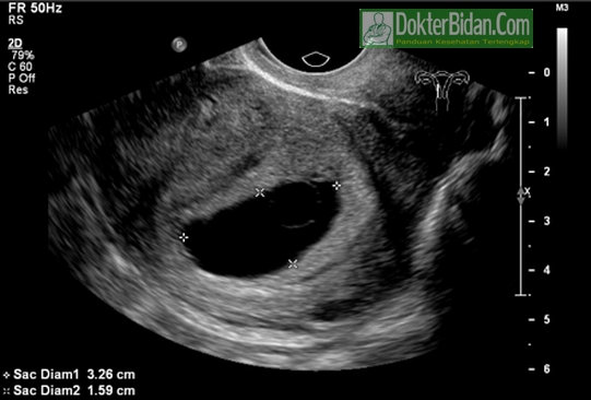 Blighted Ovum Kehamilan Anembryonic - Penyebab, Gejala, Diagnosis Dan Cara Mengobatinya Blighted Ovum Kehamilan Anembryonic - Penyebab, Gejala, Diagnosis Dan Cara Mengobatinya