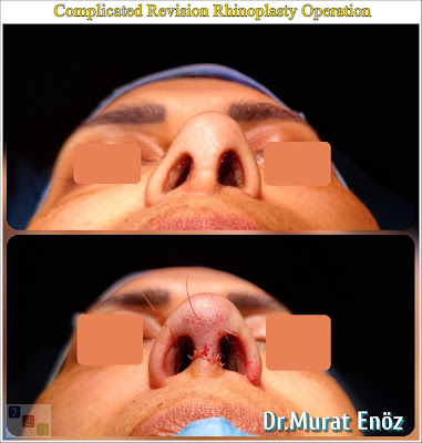 Revision rhinoplasty using rib cartilage,Secondary rhinoplasty,revision nose aesthetic surgery,Revision nose job in Istanbul