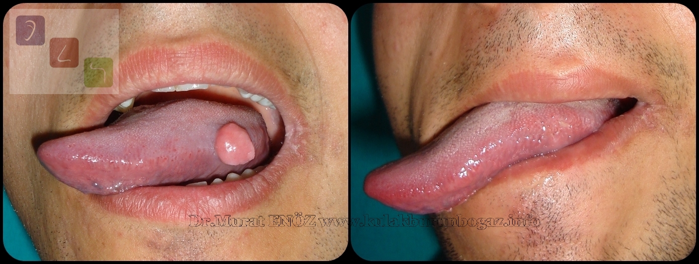 Human papillomavirus infection tongue - Paraziti in plamani, Squamous papilloma on tongue